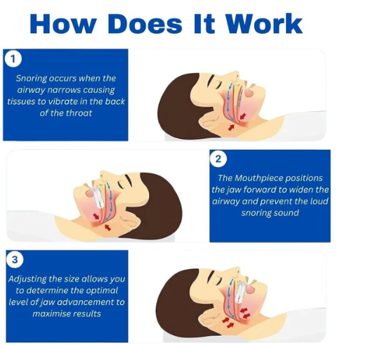 Anti-Snore Mouthpiece